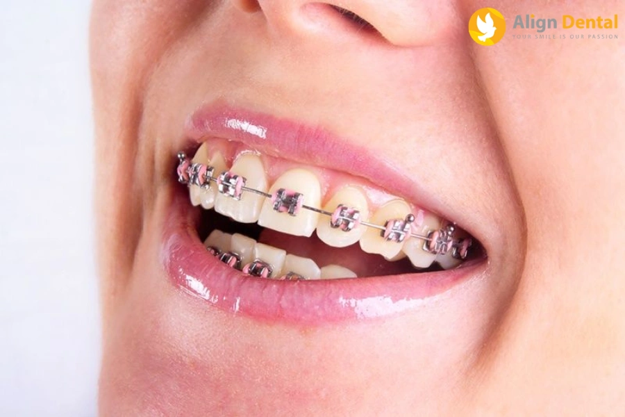 Niềng Răng Bị Hóp Má, Hóp Thái Dương - Nguyên Nhân Do Đâu?