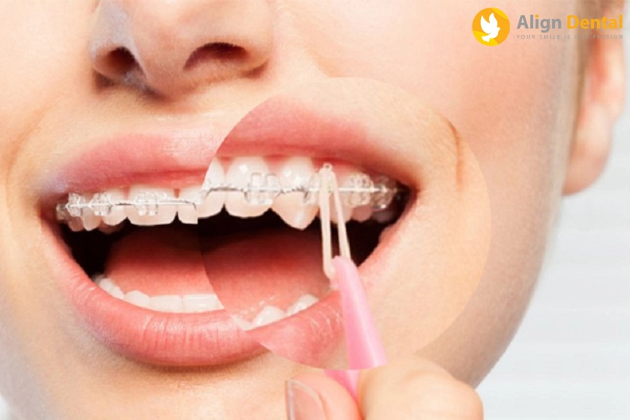 Dây Thun Niềng Răng Là Gì? 3 Loại Dây Thun Phổ Biến Hiện Nay