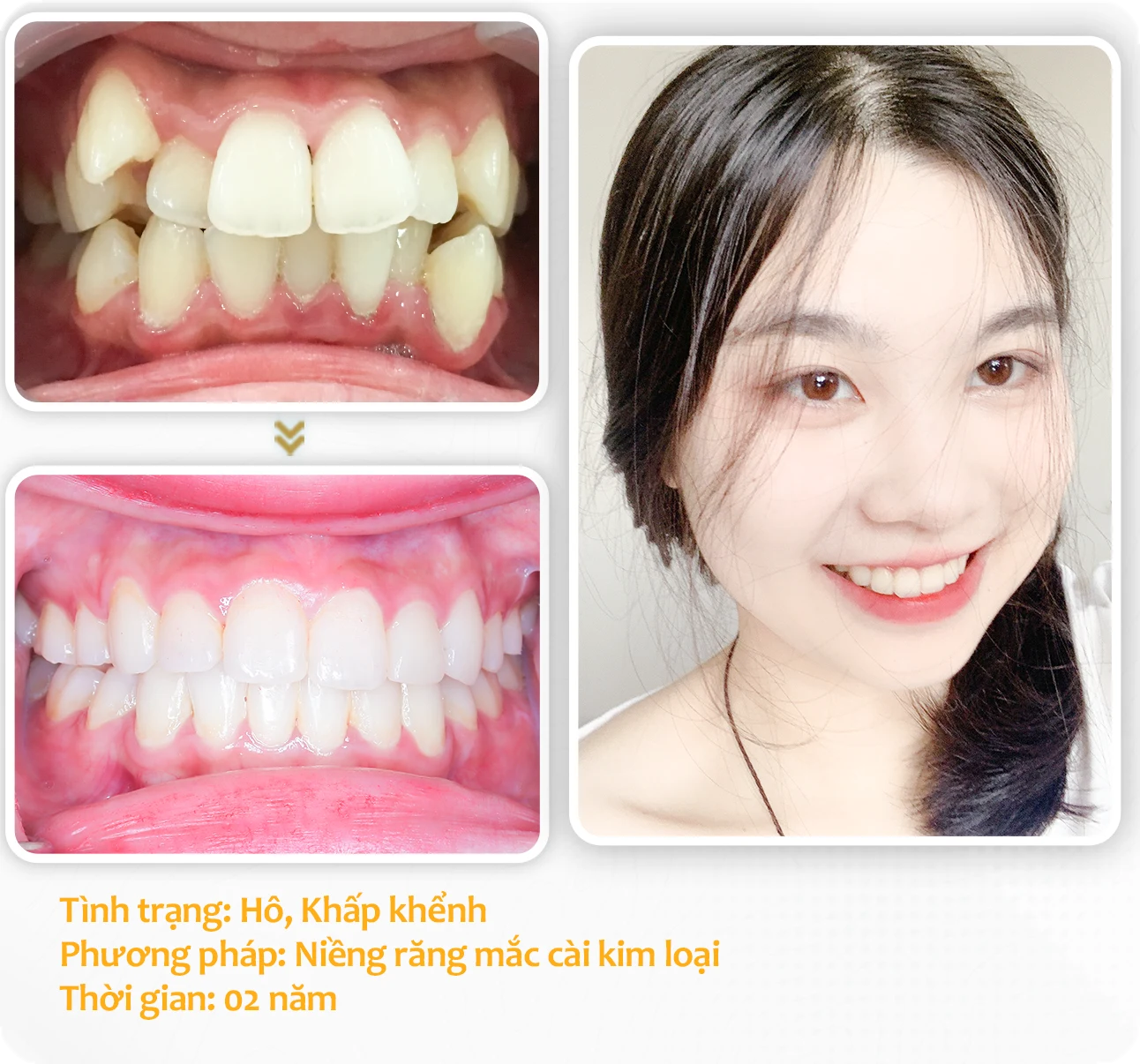 aligndental