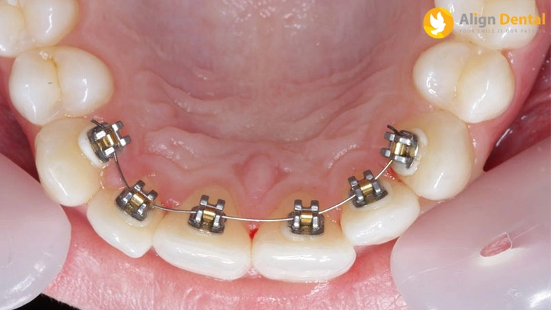 các loại niềng răng
