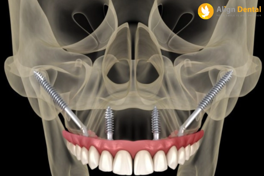 Cấy Ghép Implant Xương Gò Má Là Gì? Có Hiệu Quả Không?