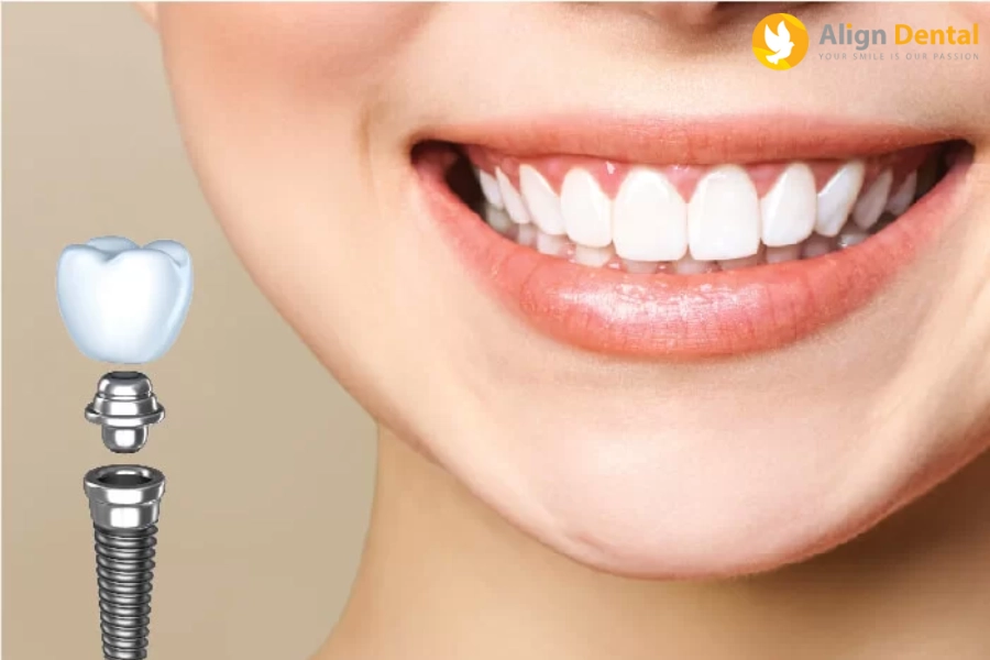 #4 Bước Xét Nghiệm Quan Trọng Trước Khi Cấy Ghép Implant