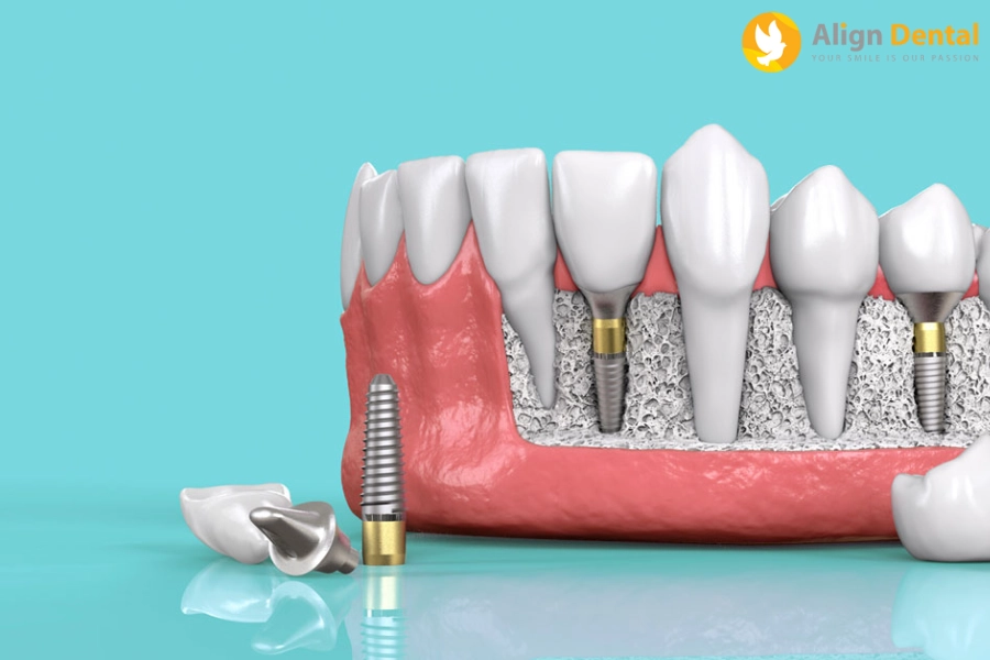 Tư Vấn Trồng Răng Implant - Những Điều Cần Chuẩn Bị Trước Khi Thực Hiện