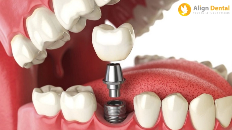 trồng răng implant