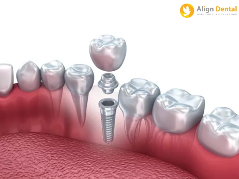 Địa chỉ trồng răng Implant uy tín, giá tốt tại Hà Nội