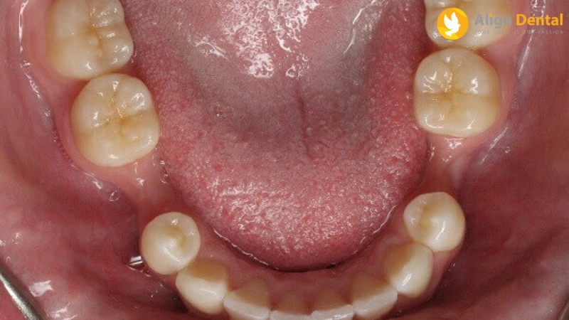 niềng răng bị hóp má