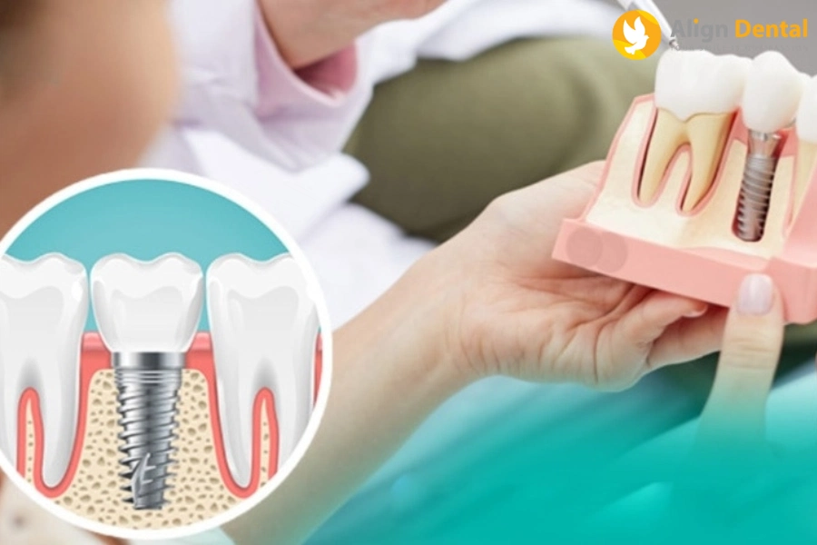 Quy Trình Trồng Răng Implant Theo Chuẩn Y Khoa Hiện Nay
