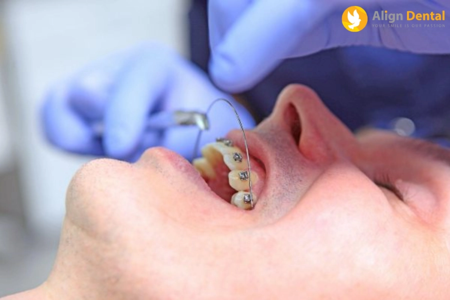 Nguyên Nhân Bị Dây Cung Đâm Vào Má? Cách Xử Lý Nhanh Chóng?