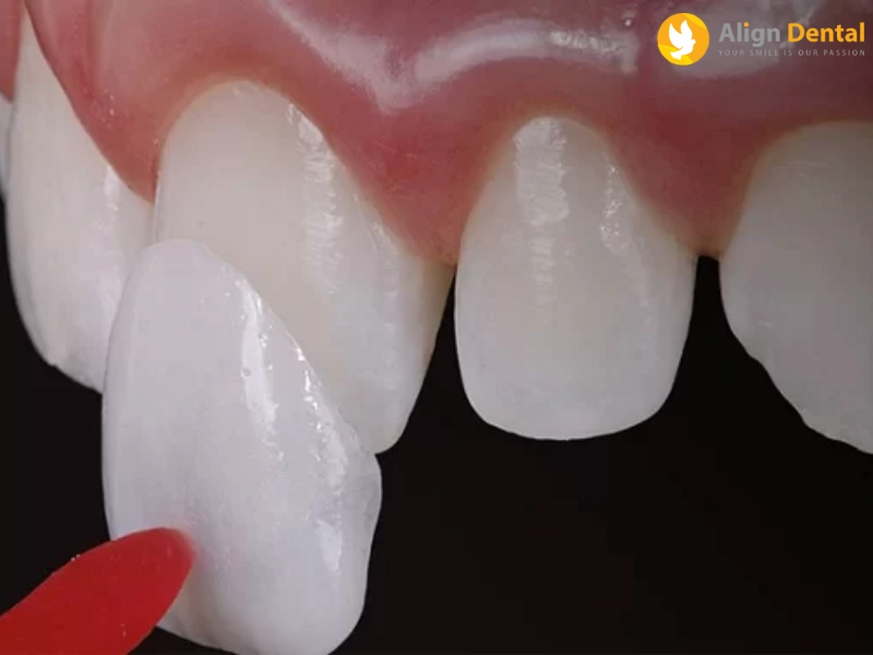 dán sứ veneer