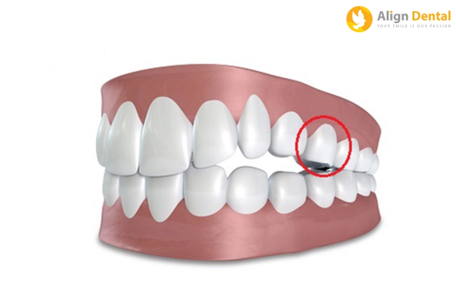 #Trồng Răng Số 5 Giá Bao Nhiêu? Nên Dùng Phương Pháp Nào?