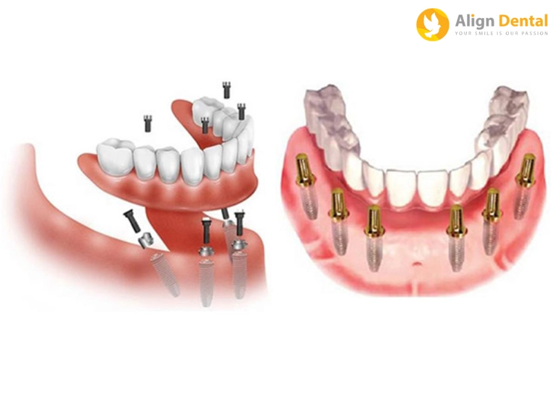 Trụ Implant Hiossen có nhiều ưu điểm nổi bật