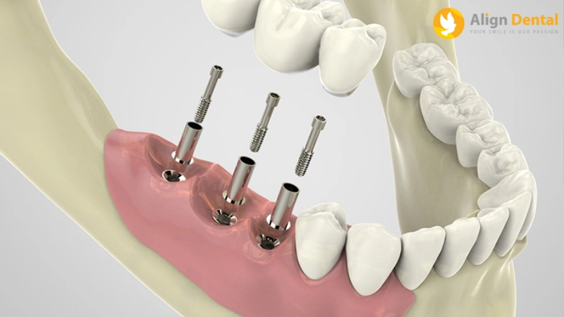 mất răng lâu năm có trồng được không