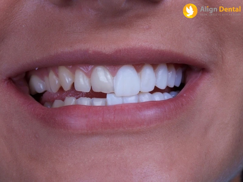 dán sứ veneer