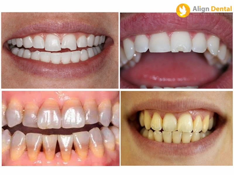 dán sứ veneer