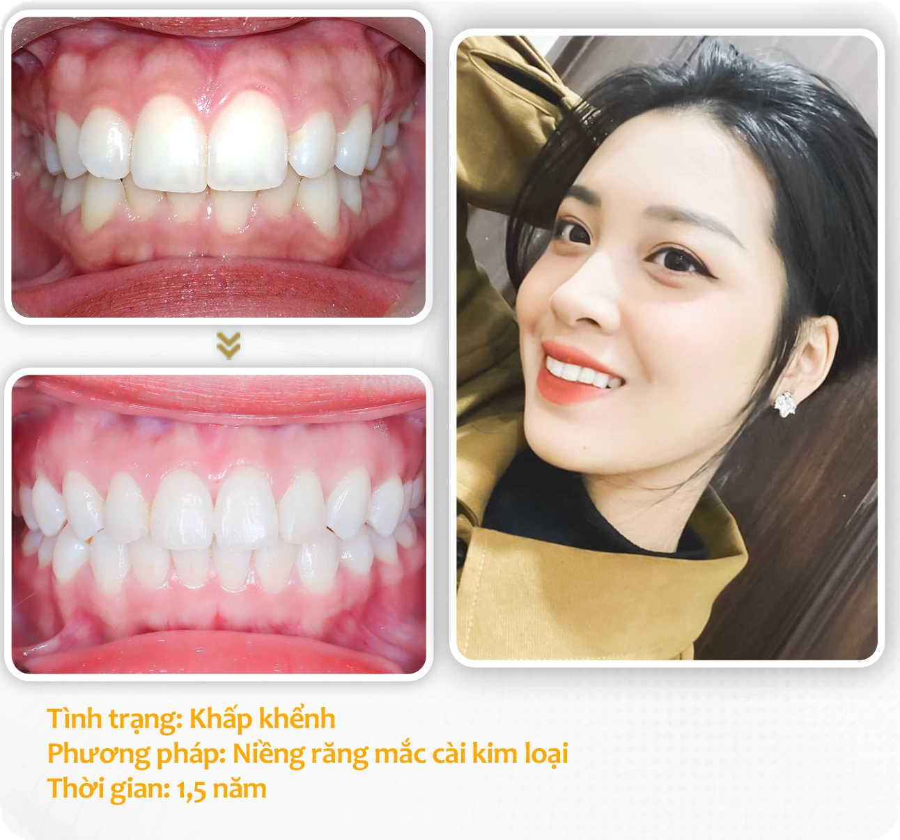 aligndental