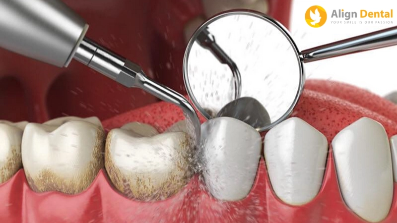viêm quanh implant
