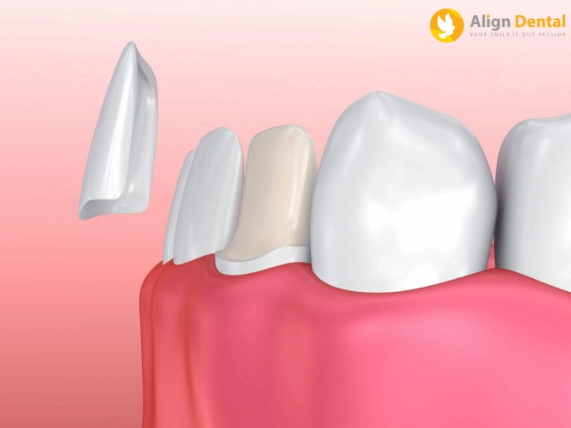 dán sứ veneer