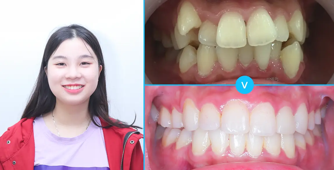 aligndental