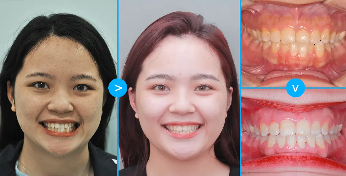 aligndental