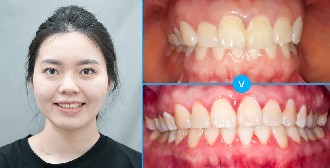 aligndental