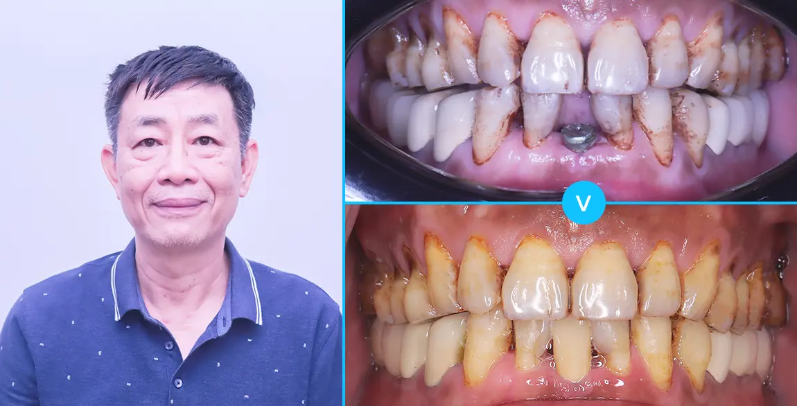 aligndental